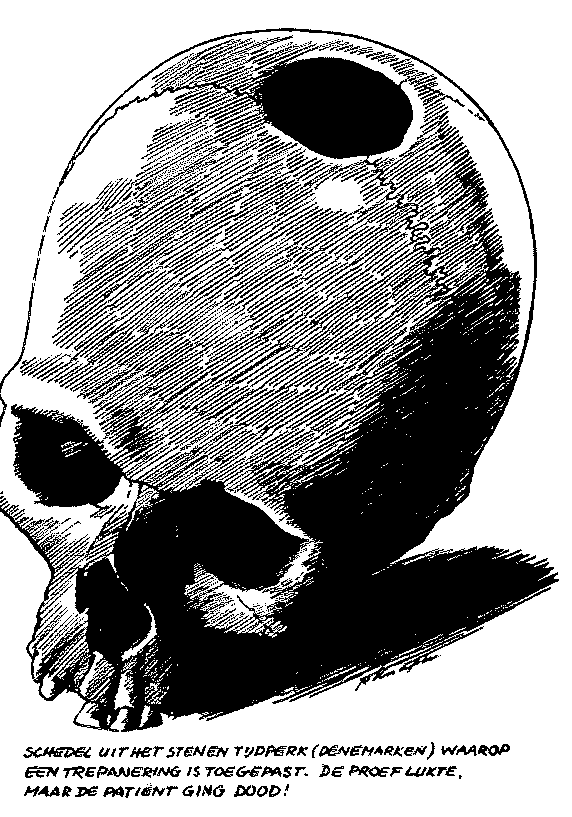 trepanning